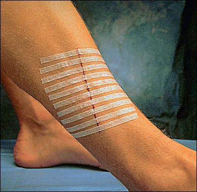 Steri strip